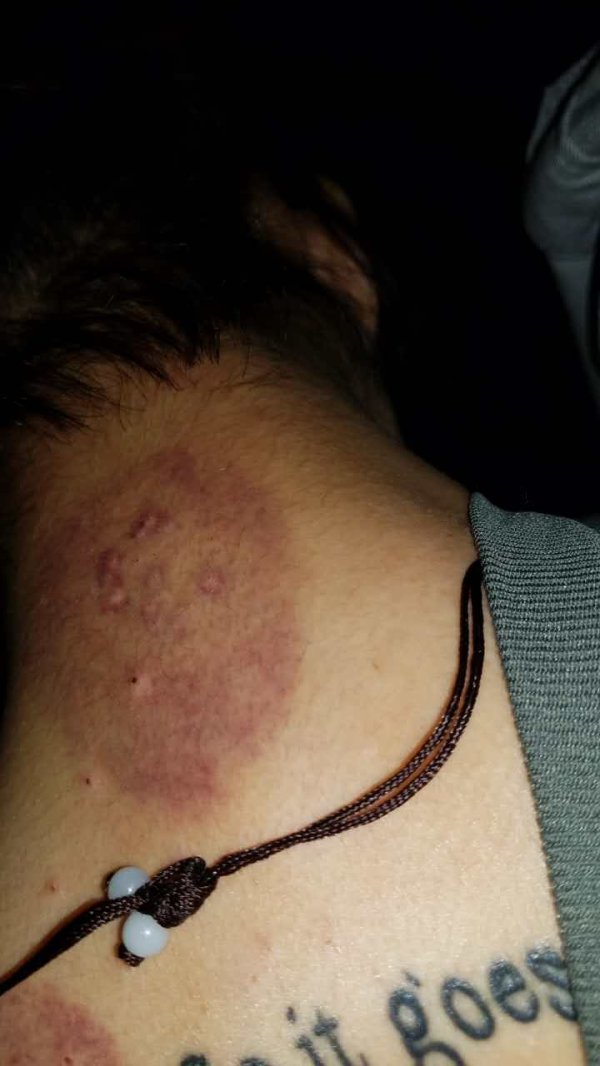 会阴,裂伤,缝合,怎么,护理