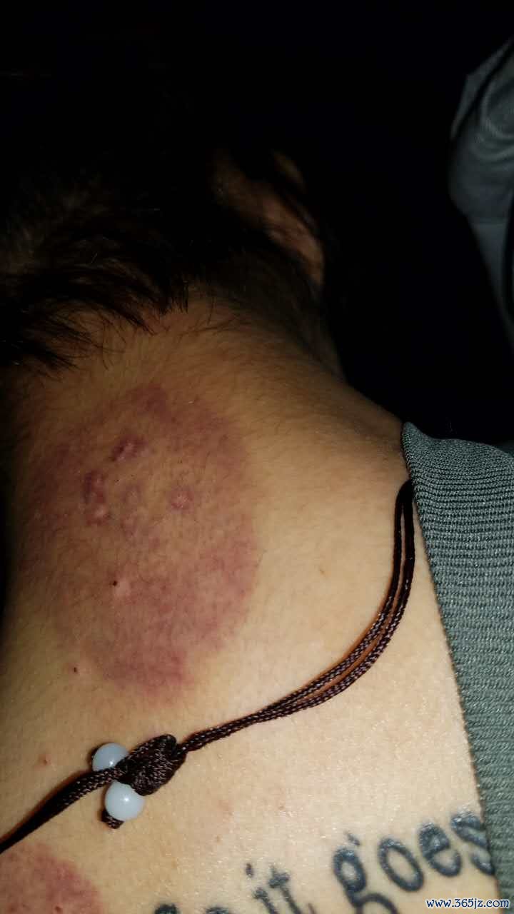 会阴裂伤缝合后怎么护理才能不留疤痕