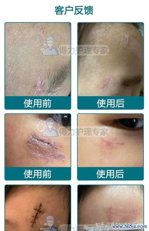 会阴裂伤缝合后怎么护理才能不留疤痕