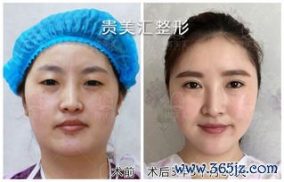 小整形手术方式：小整形与私密整形、缩小术