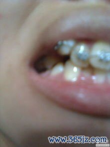 出牙：几颗牙正常