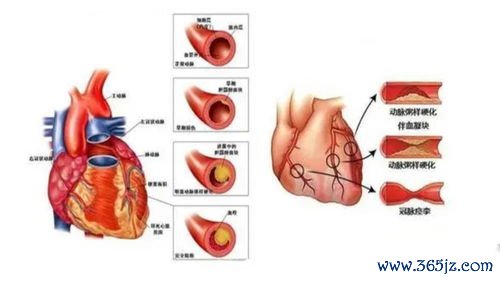冠心病：冠脉狭窄50%算冠心病吗？到底要不要放支架？