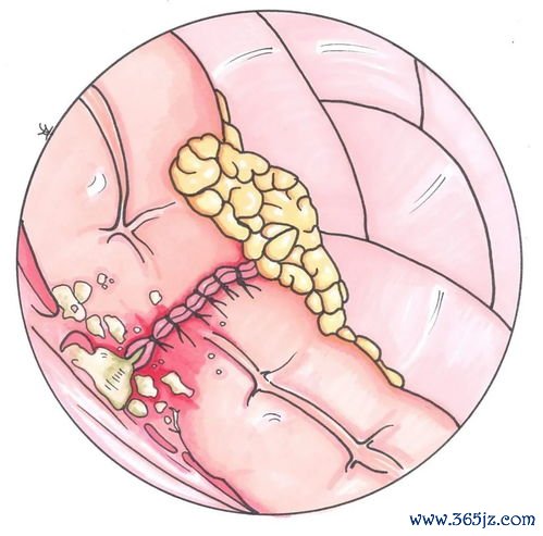 冠心病：冠脉狭窄50%算冠心病吗？到底要不要放支架？