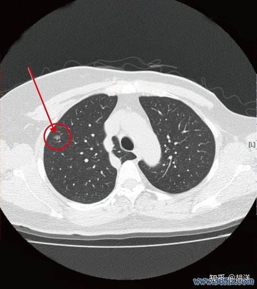 囊肿,癌变,怎么,随访