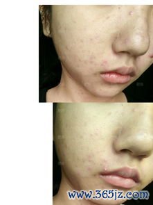 脸上长痘嘴里有口气，这是身体在告诉你毒素多了