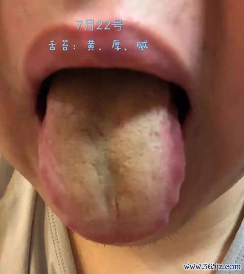 舌苔厚腻大便粘马桶，这是湿气重的典型信号