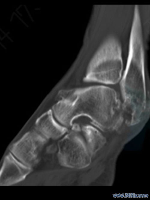 前庭部位灼热感小便时加重是炎还是尿道炎