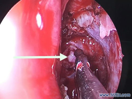 前庭大腺囊肿不手术能消退吗
