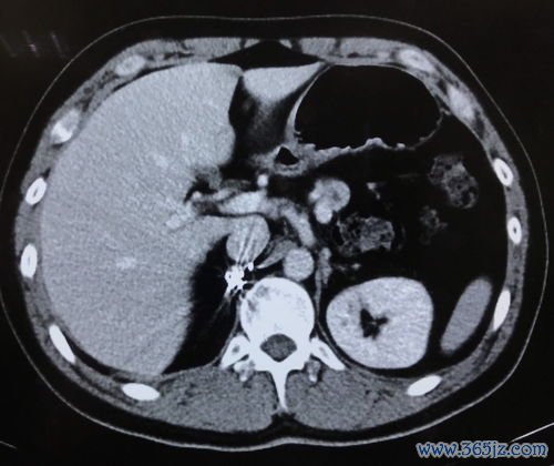 前庭大腺囊肿不手术能消退吗