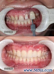 整形牙齿矫正的方法：整形牙齿与口腔正畸的治疗方案对比