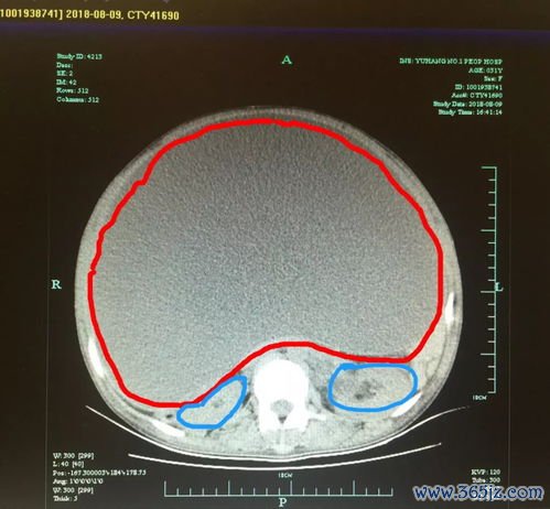 冠脉CT：做冠脉CT前，心率太快要先吃药？降心率是为什么？