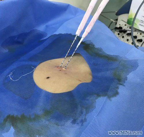 冷冻消融：冷冻冻死肿瘤