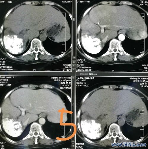 肝癌-乙肝携带者多年不复查，肚子胀发现肝癌破裂出血