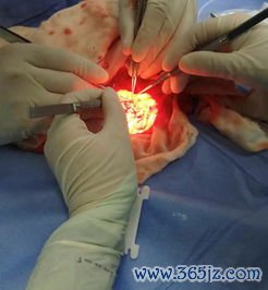 十二指肠溃疡：十二指肠破了洞——饿了疼、吃饭缓解