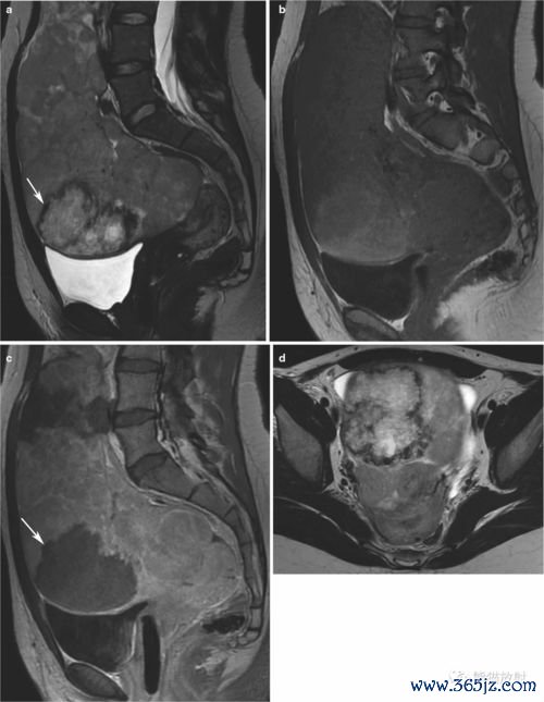 卵黄囊瘤：生殖细胞瘤