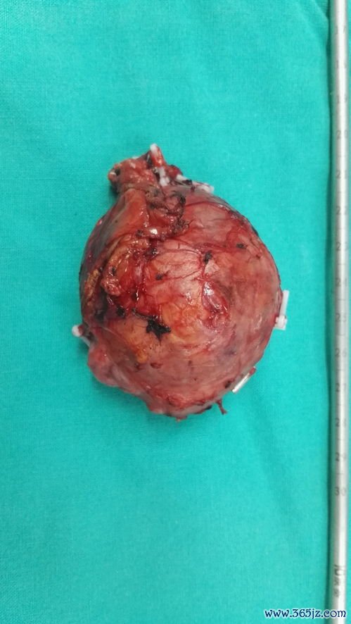 卵黄囊瘤：生殖细胞瘤