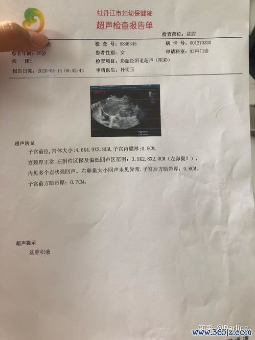 卵巢囊肿会自己消失吗生理性囊肿观察多久