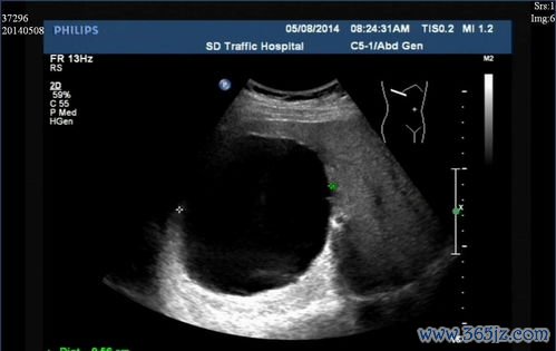 卵巢囊肿会自己消失吗生理性囊肿观察多久