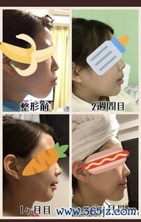 整形,要花,少钱,不同,目的