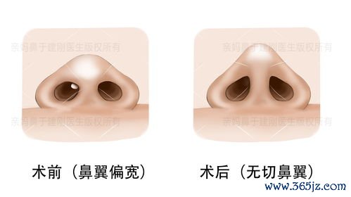 整形鼻子手术方式：整形鼻子与鼻部综合、鼻翼缩小选择