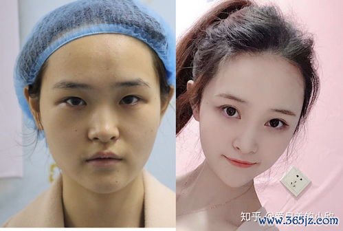 整形,鼻子,手术,方式,鼻部