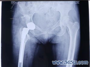 发育性髋关节发育不良：DDH