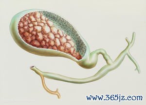 原发性胆汁性肝硬化：胆管被攻击，碱性磷酸酶高