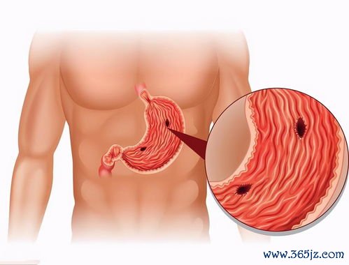 反酸：酸水涌到嗓子眼烧得慌，胃食管反流了