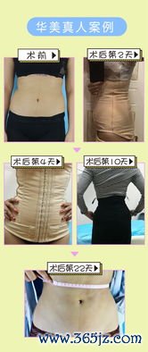 溶脂减肥安全吗，溶脂针和溶脂仪哪个效果好