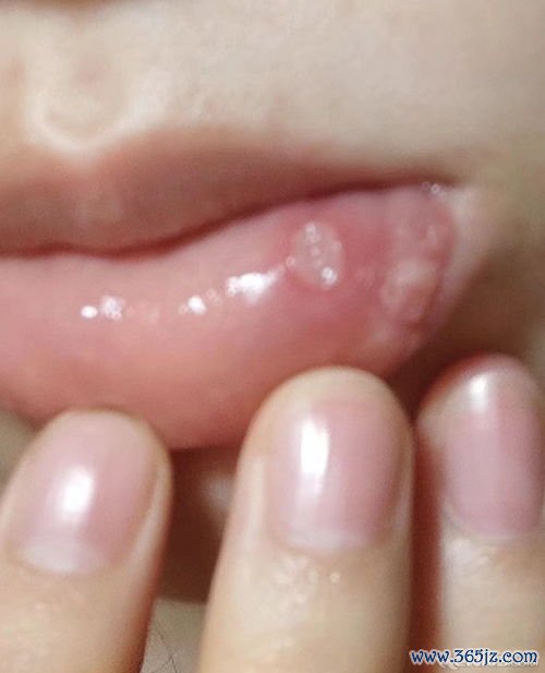 口腔溃疡：反复长溃疡，查风湿