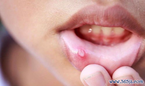 口腔溃疡：反复长溃疡，查风湿