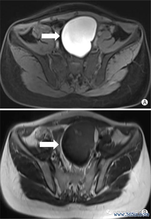 卵巢髓质囊肿是什么