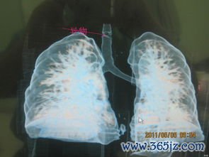 呼吸道感染：鼻子、嗓子、气管发炎——病毒细菌都可能