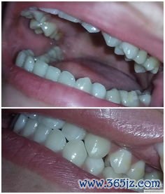 牙科整形包括哪些？牙科整形与牙齿矫正、牙齿美容