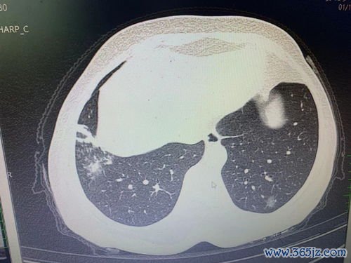 咯血：痰里带血丝别慌，先分清是牙血还是肺里来的