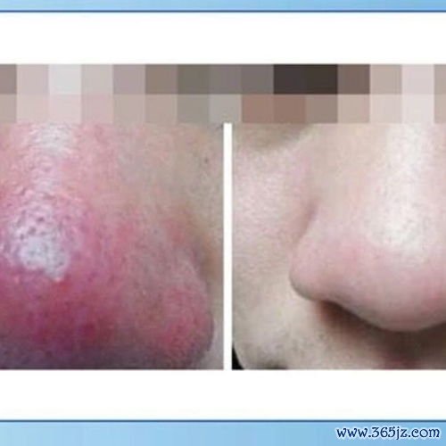 咯血：痰里带血丝别慌，先分清是牙血还是肺里来的