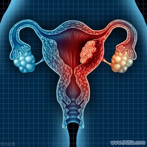 卵巢髓质囊肿是良性还是恶性需要手术吗