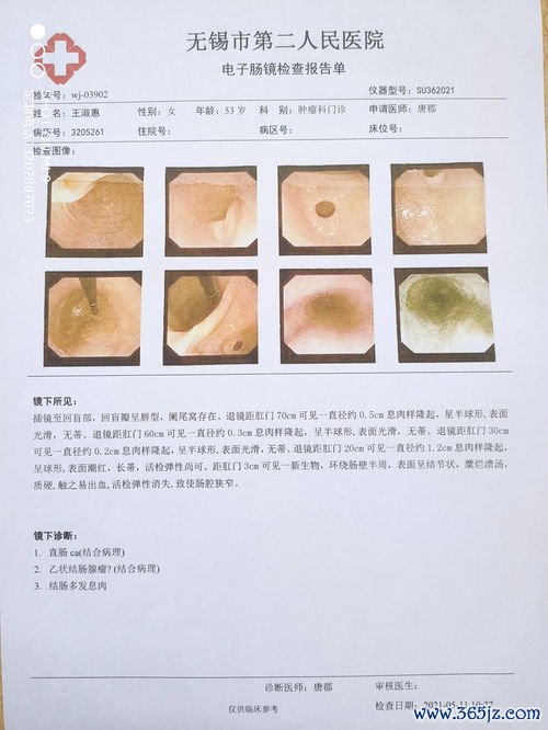 卵泡膜细胞增生症是什么病影响排卵和怀孕吗