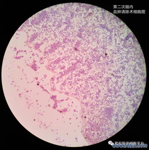 卵泡膜细胞增生症是什么病影响排卵和怀孕吗