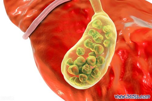 卵泡膜细胞增生症是什么病