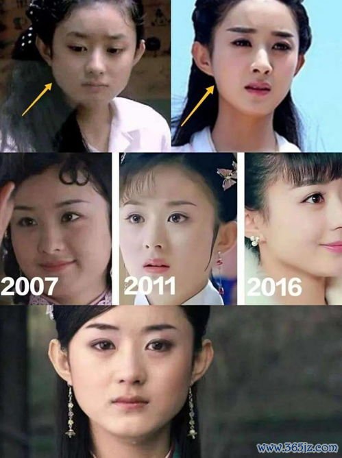 瘦脸,整形,手术,方法,面部