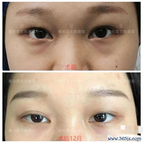 眼睛整形手术方法：眼睛整形与双眼皮、眼袋手术选择