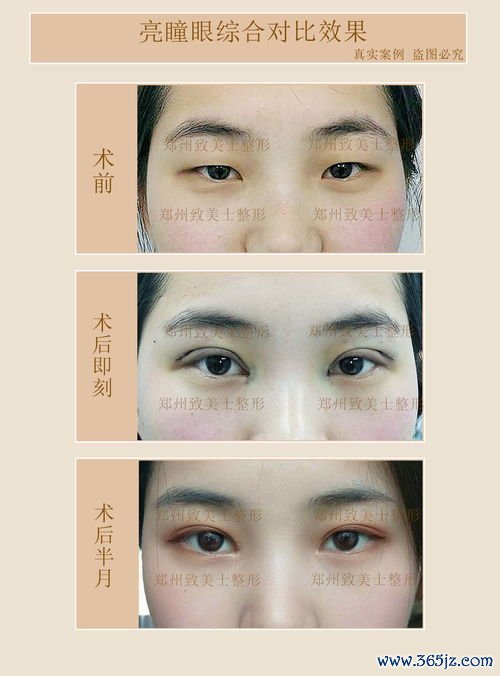 眼睛,整形,手术,方法,双眼皮