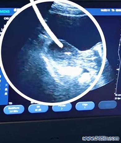 做试管婴儿去哪里