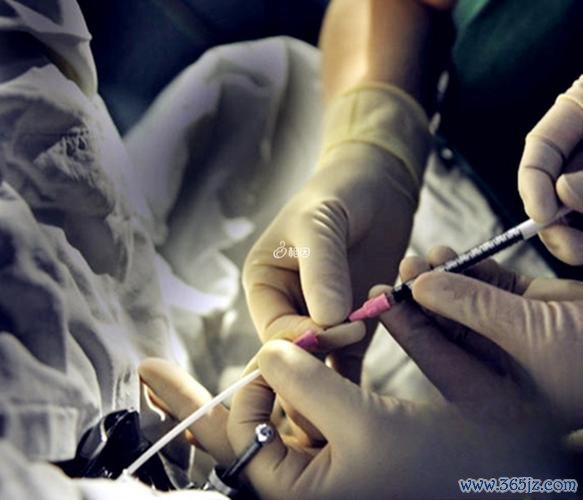 做试管婴儿取卵过程