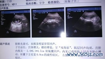 双角子宫容易流产吗