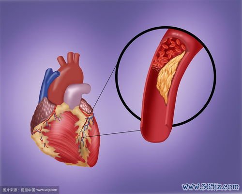 心肌梗死术后饮食心脏支架后怎么吃才能防复发