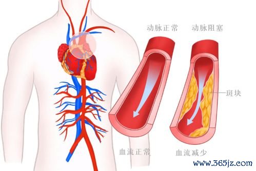 心肌梗死术后饮食心脏支架后怎么吃才能防复发