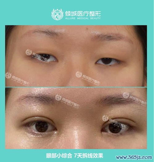 眼部,整形,医院,排名,综合