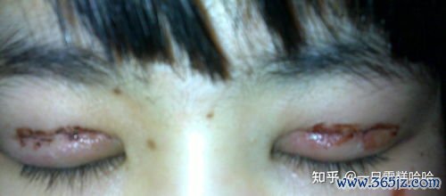 反复,种植,失败,内膜,容受